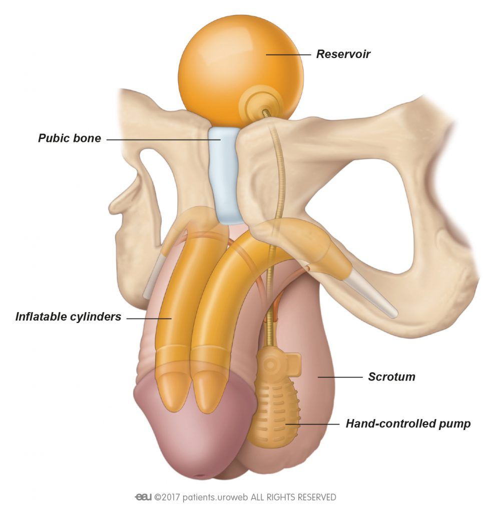 Fig. 1: A common type of inflatable penile implant.